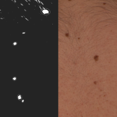 A side by side composite of a patient's back showing a few moles (right), and the same moles in white on a black background (left), looking like stellar objects.