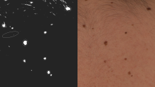 A side by side composite of a patient's back showing a few moles (right), and the same moles in white on a black background (left), looking like stellar objects.